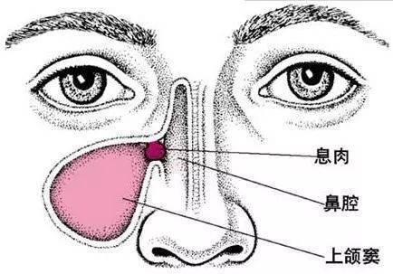 小小鼻息肉，危害竟然这么大？
