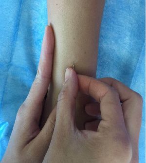 中医护理适宜技术之—腕踝针-友友