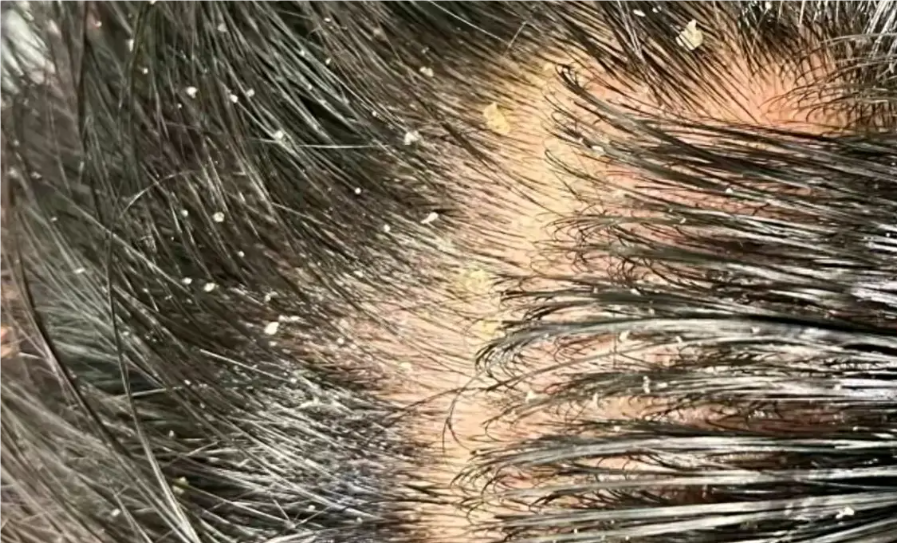 头发出油脱发怎么解决？这份终极指南请收好！告别油腻，远离脱发困扰，从今天开始！