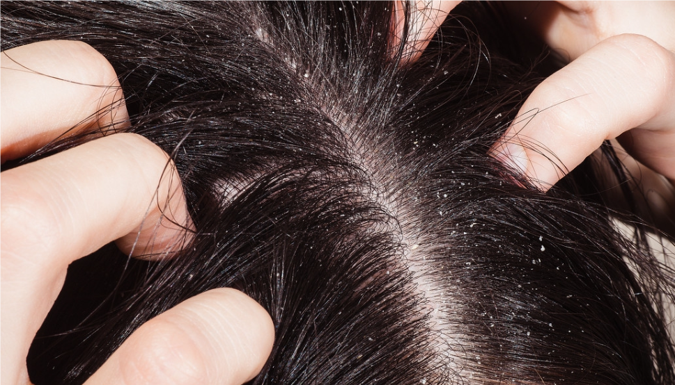 头皮痒是什么原因？怎么解决？全面解析头皮痒的成因与解决方案