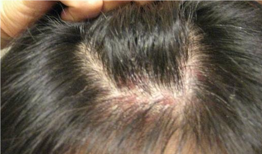 脂溢性皮炎头皮怎么治疗最彻底？全面解析脂溢性皮炎的治疗方法