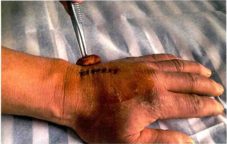 无菌敷料怎么用【图说】外科换药流程-感控操作图解_https://www.jmylbn.com_新闻资讯_第16张