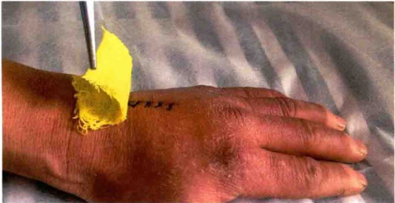 无菌敷料怎么用【图说】外科换药流程-感控操作图解_https://www.jmylbn.com_新闻资讯_第12张