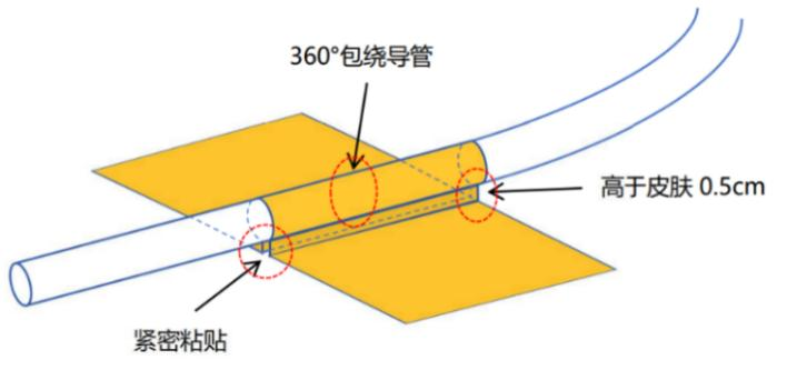尿液引流袋怎么用留置尿管患者回家后滑脱怎么办，如何防感染？这里有居家护理妙招_https://www.jmylbn.com_新闻资讯_第2张