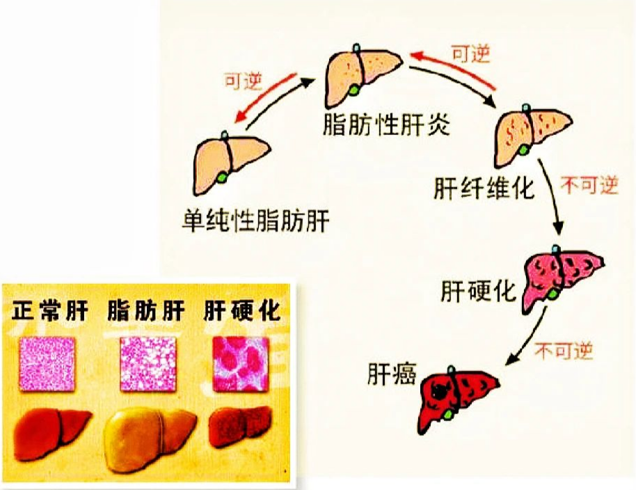 脂肪肝怎样减肥