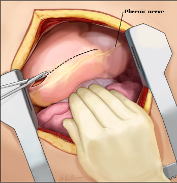 动脉钳怎么用复苏性开胸术_https://www.jmylbn.com_新闻资讯_第4张