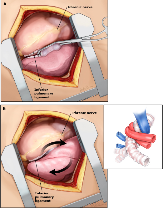 动脉钳怎么用复苏性开胸术_https://www.jmylbn.com_新闻资讯_第3张