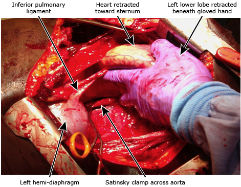 动脉钳怎么用复苏性开胸术_https://www.jmylbn.com_新闻资讯_第6张