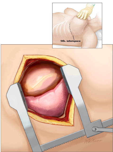 动脉钳怎么用复苏性开胸术_https://www.jmylbn.com_新闻资讯_第1张
