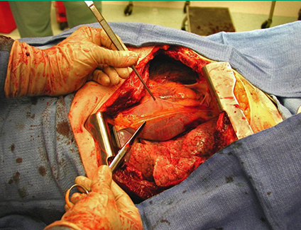 动脉钳怎么用复苏性开胸术_https://www.jmylbn.com_新闻资讯_第5张