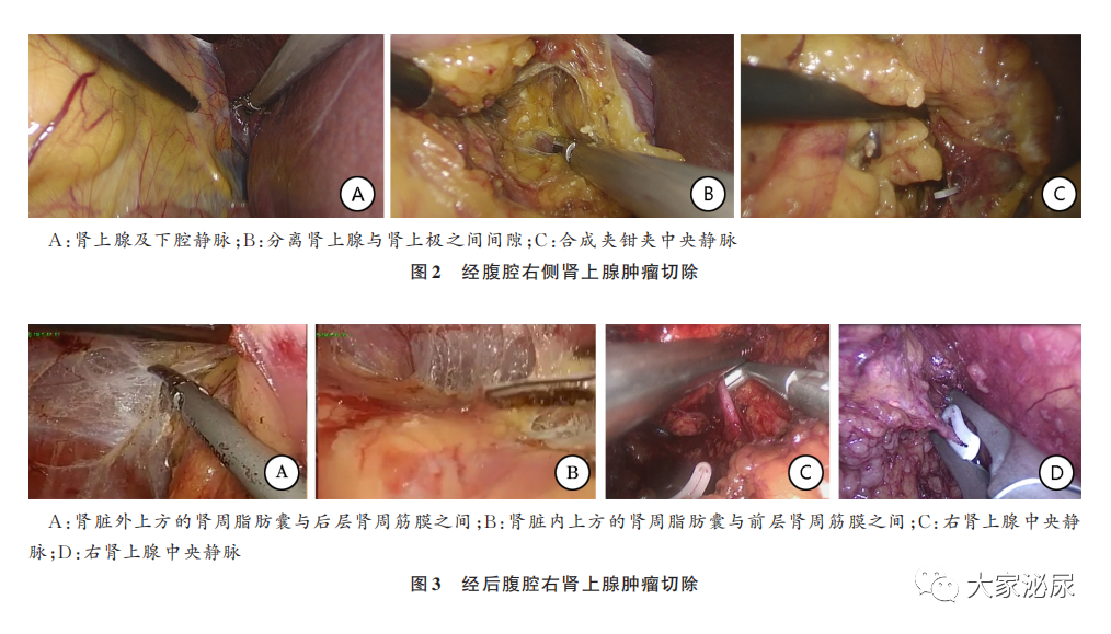 縱行切開 gerota 筋膜,於脂肪囊外遊離顯露腎臟上半部分,據腫瘤位置及