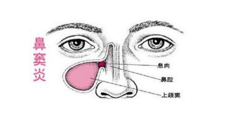 鼻窦炎是个大麻烦，千万不可小瞧