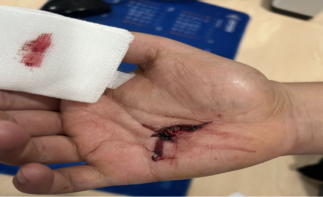 怎么促进vsd伤口愈合爱犬啊呜一口，手掌血肉模糊，巧用VSD技术治疗_https://www.jmylbn.com_新闻资讯_第4张