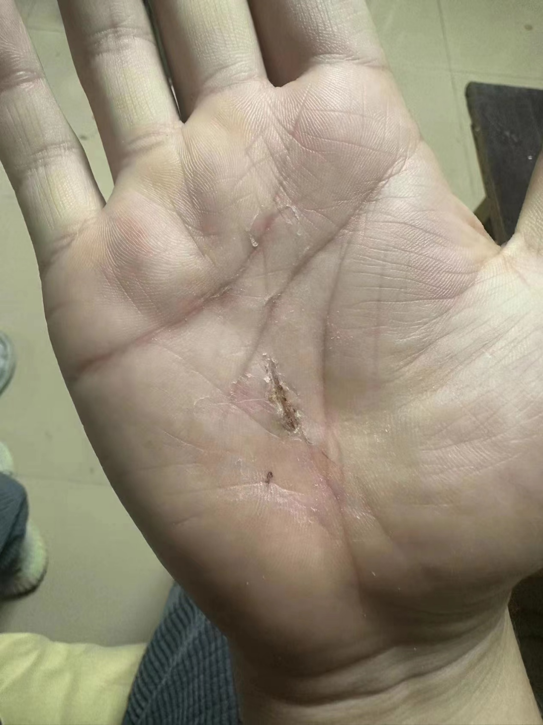 怎么促进vsd伤口愈合爱犬啊呜一口，手掌血肉模糊，巧用VSD技术治疗_https://www.jmylbn.com_新闻资讯_第7张