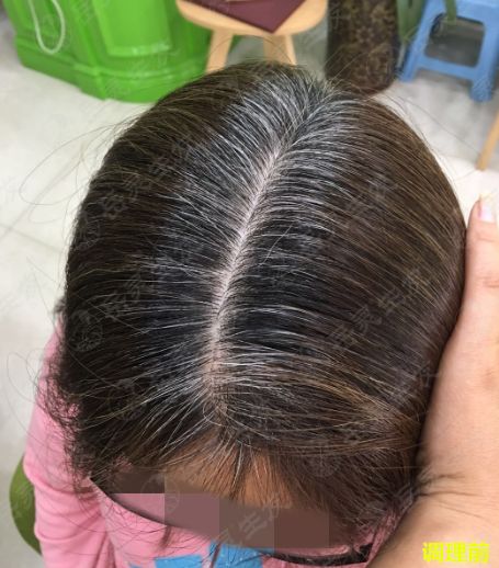 岳灵生发调理前