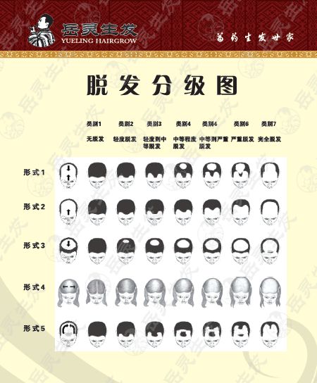 岳灵生发脱发分级图