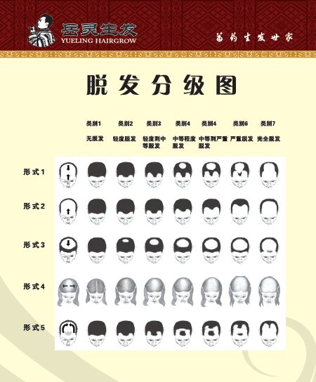 岳灵生发脱发分级图