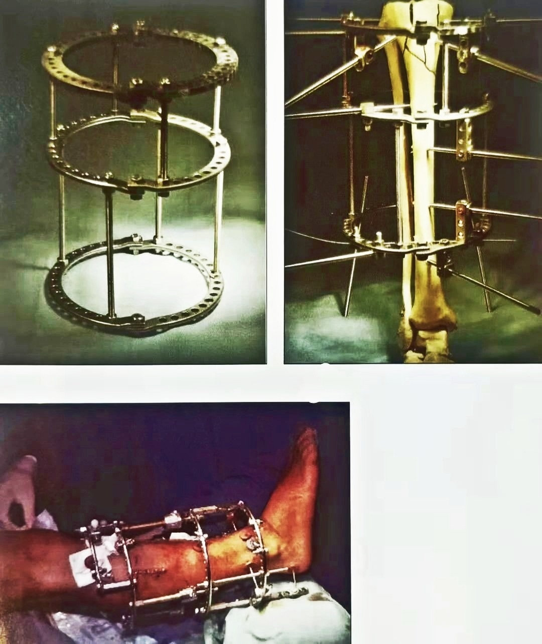 什么是外固定架胫骨近端骨折：环形外固定架_https://www.jmylbn.com_新闻资讯_第19张