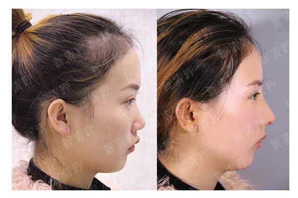 耳軟骨綜合隆鼻半個月了，分享恢復果照片~