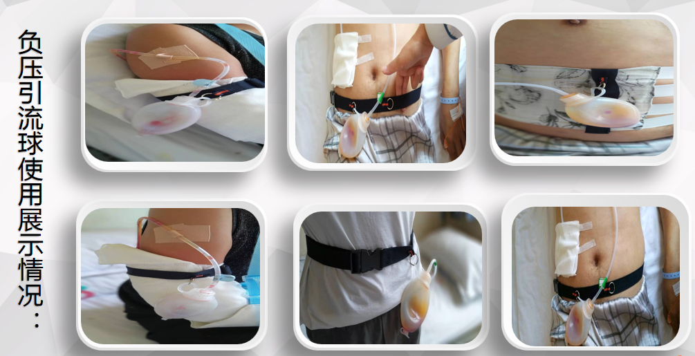 引流球有什么作用骨科术后负压引流球固定袋的设计与应用_https://www.jmylbn.com_新闻资讯_第4张