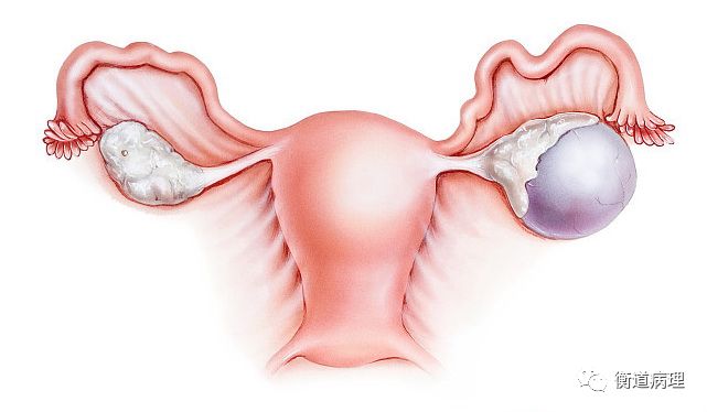 卵巢常见囊肿性病变汇总_医学界-助力医生临床决策和职业成长