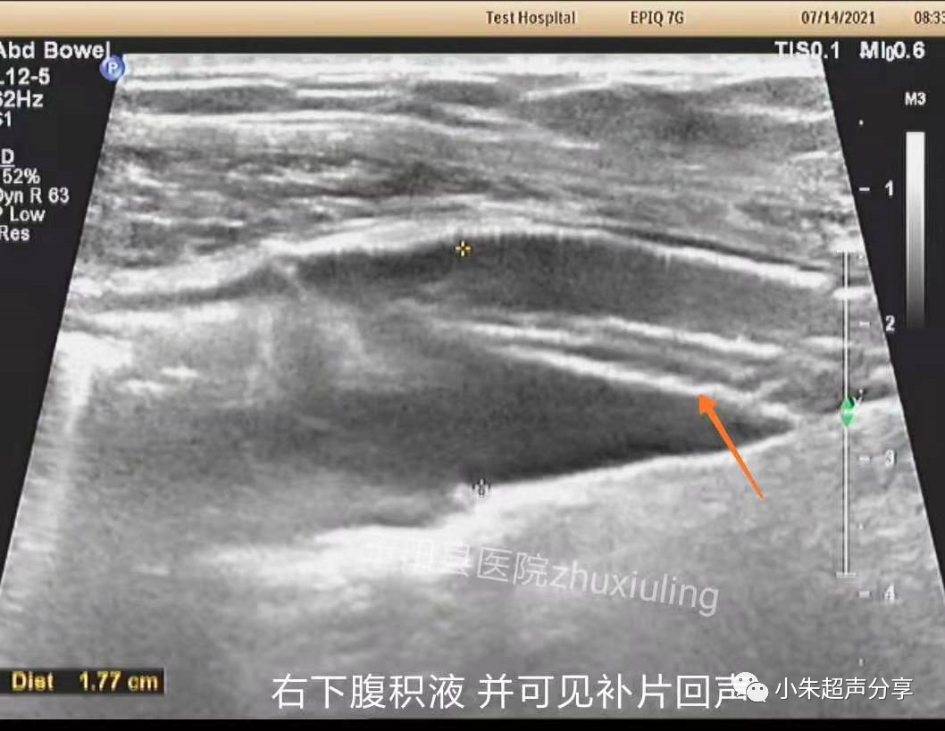 什么是疝气补片原来 “补片” 是这样子的_https://www.jmylbn.com_新闻资讯_第1张