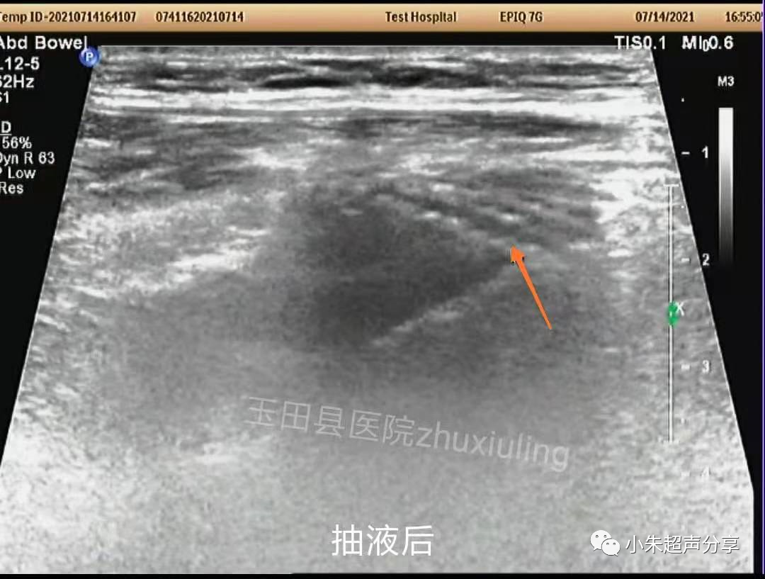 什么是疝气补片原来 “补片” 是这样子的_https://www.jmylbn.com_新闻资讯_第7张