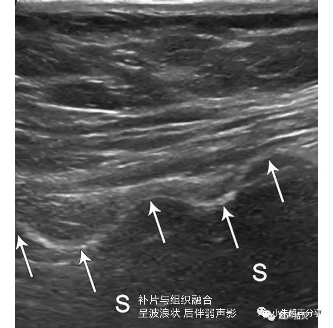 什么是疝气补片原来 “补片” 是这样子的_https://www.jmylbn.com_新闻资讯_第18张