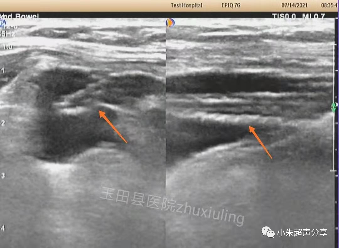 什么是疝气补片原来 “补片” 是这样子的_https://www.jmylbn.com_新闻资讯_第2张