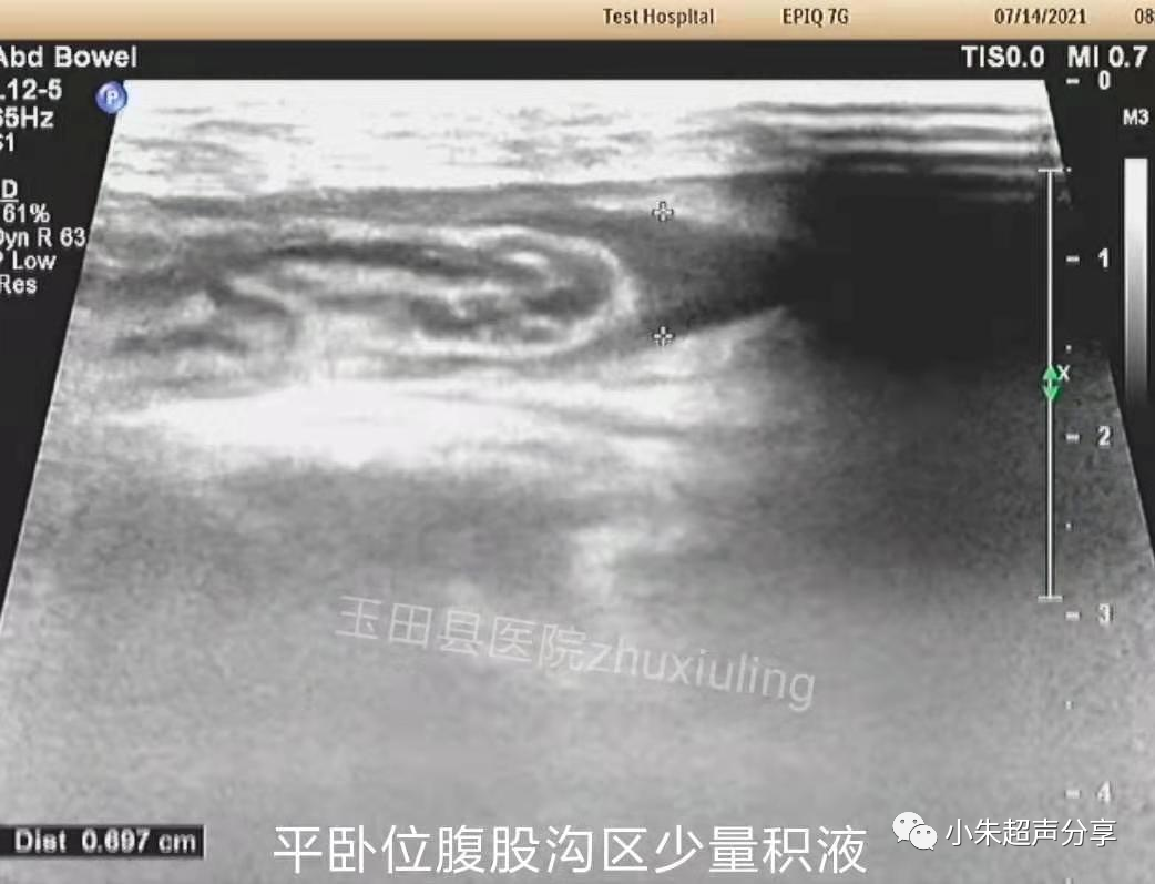 什么是疝气补片原来 “补片” 是这样子的_https://www.jmylbn.com_新闻资讯_第3张