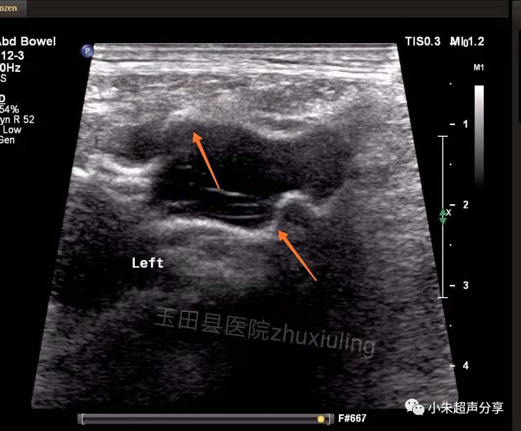 什么是疝气补片原来 “补片” 是这样子的_https://www.jmylbn.com_新闻资讯_第10张
