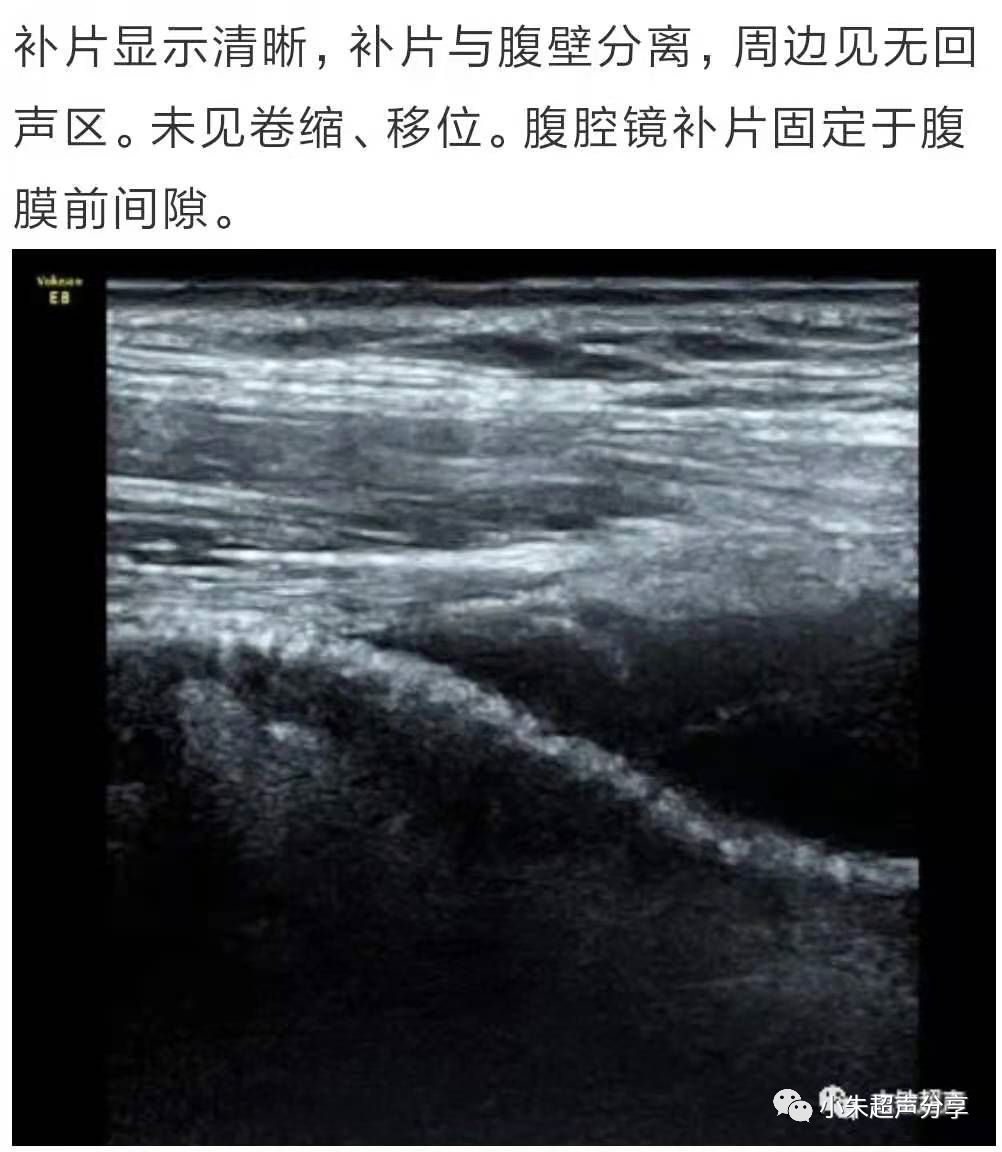 什么是疝气补片原来 “补片” 是这样子的_https://www.jmylbn.com_新闻资讯_第17张