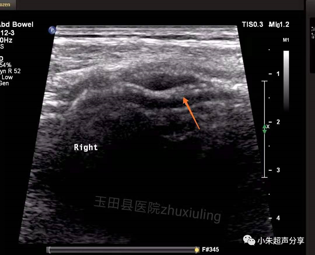 什么是疝气补片原来 “补片” 是这样子的_https://www.jmylbn.com_新闻资讯_第12张