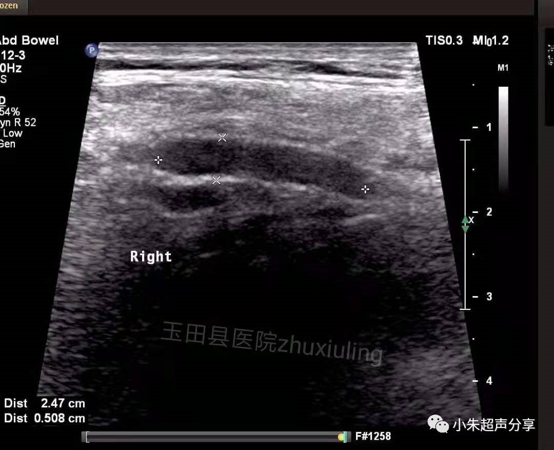 什么是疝气补片原来 “补片” 是这样子的_https://www.jmylbn.com_新闻资讯_第11张