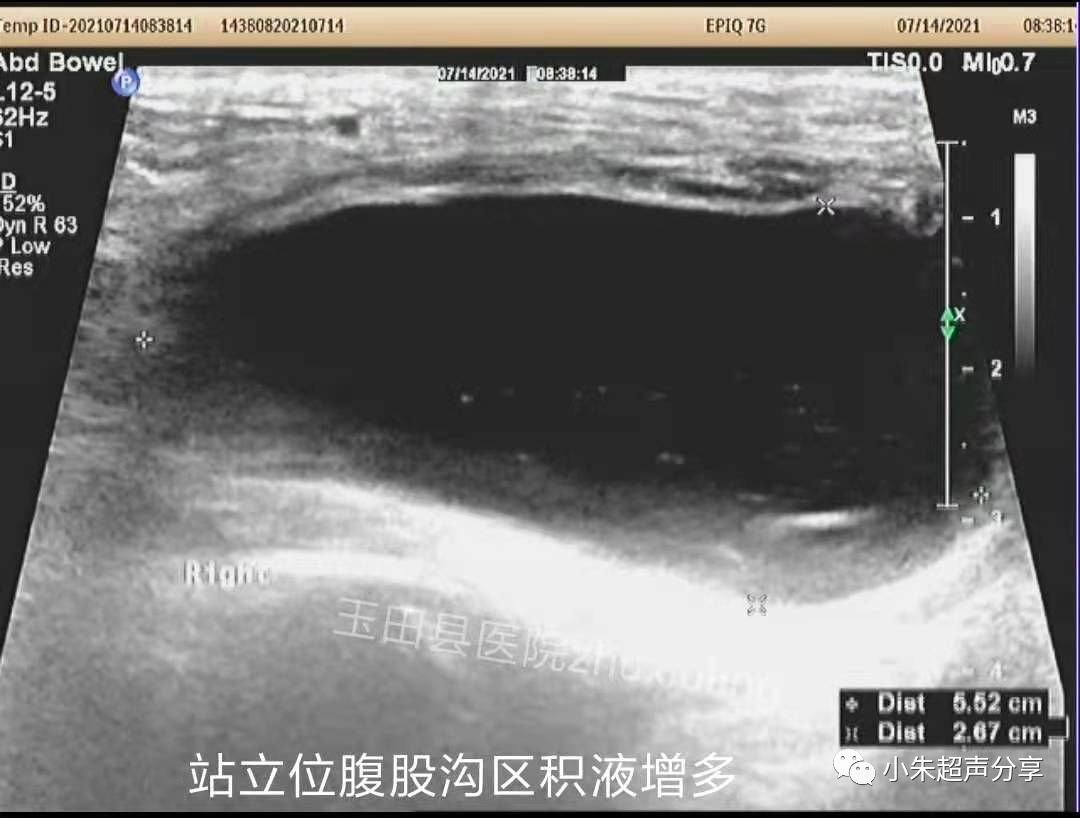 什么是疝气补片原来 “补片” 是这样子的_https://www.jmylbn.com_新闻资讯_第4张