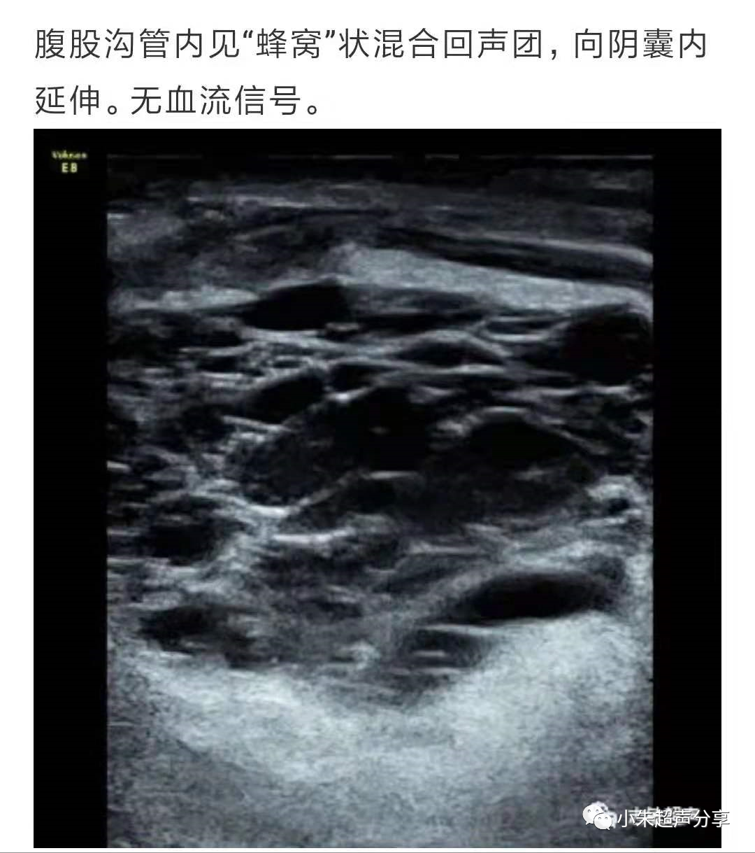 什么是疝气补片原来 “补片” 是这样子的_https://www.jmylbn.com_新闻资讯_第21张