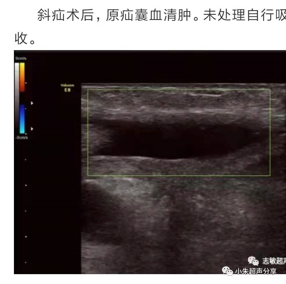 什么是疝气补片原来 “补片” 是这样子的_https://www.jmylbn.com_新闻资讯_第20张