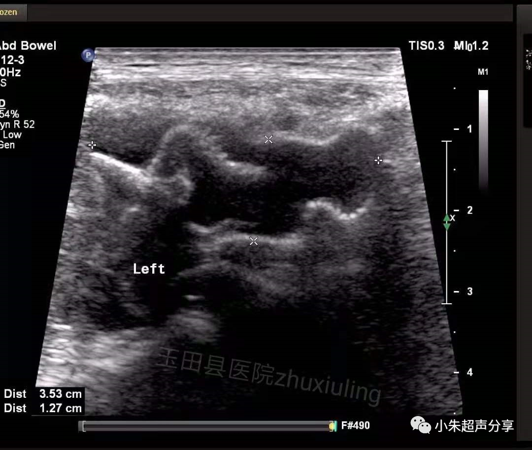什么是疝气补片原来 “补片” 是这样子的_https://www.jmylbn.com_新闻资讯_第8张