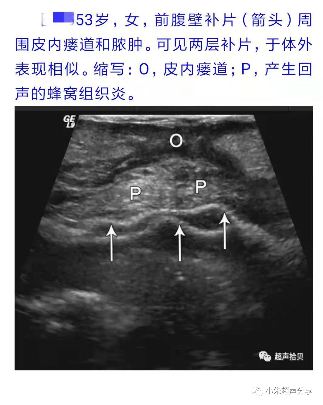 什么是疝气补片原来 “补片” 是这样子的_https://www.jmylbn.com_新闻资讯_第19张