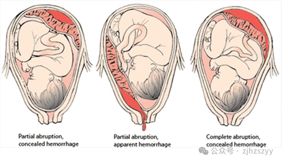 止血纱布怎么用止血纱布用了三排、整个器官青紫……这个位置“动”一下，差点命都没了_https://www.jmylbn.com_新闻资讯_第6张