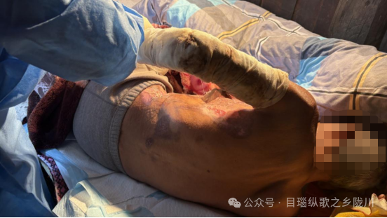 换药包里包含哪些换药包里的温度——护士尹利华_https://www.jmylbn.com_新闻资讯_第2张