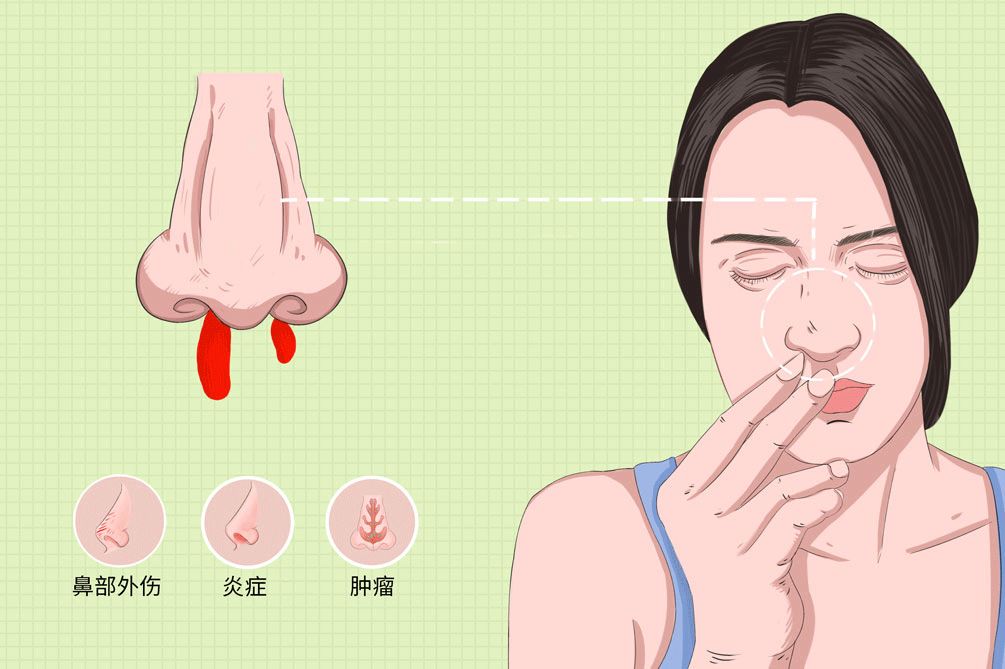 鼻子出血的原因，鼻出血怎么办？