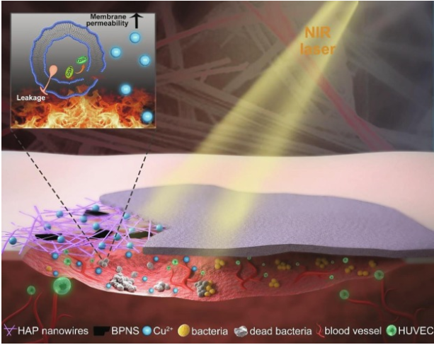 壳聚糖敷料什么时候用【专题集锦】用于细菌感染伤口愈合的创面敷料（12篇）_https://www.jmylbn.com_新闻资讯_第10张