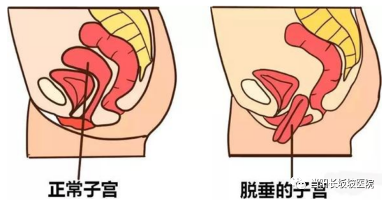 盆底康复治疗仪怎么用关注｜盆底肌康复治疗仪，女性的福音_https://www.jmylbn.com_新闻资讯_第3张