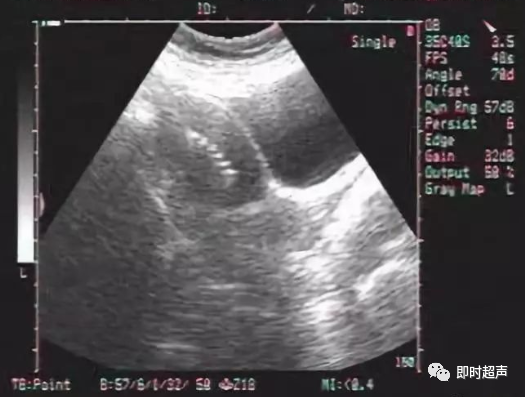 子宫支架怎么取B超诊断宫内节育器位置的标准_https://www.jmylbn.com_新闻资讯_第2张