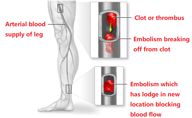 什么是外周支架获批FDA！最大号外周动脉取栓支架_https://www.jmylbn.com_新闻资讯_第3张