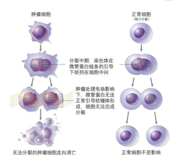 Optima什么医疗西格玛医学洞见：一文读懂肿瘤电场治疗及临床试验设计_https://www.jmylbn.com_新闻资讯_第4张