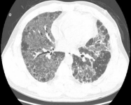ero为什么不显示叶俏教授：HRCT是发现和鉴别「过敏性肺炎」的重要环节，何种表现指向预后不良？使患者发病的危害因素躲在哪些环境中？_https://www.jmylbn.com_新闻资讯_第17张