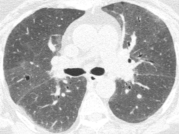 ero为什么不显示叶俏教授：HRCT是发现和鉴别「过敏性肺炎」的重要环节，何种表现指向预后不良？使患者发病的危害因素躲在哪些环境中？_https://www.jmylbn.com_新闻资讯_第4张