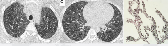 ero为什么不显示叶俏教授：HRCT是发现和鉴别「过敏性肺炎」的重要环节，何种表现指向预后不良？使患者发病的危害因素躲在哪些环境中？_https://www.jmylbn.com_新闻资讯_第52张